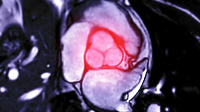 What Is Aortic Valve Stenosis?