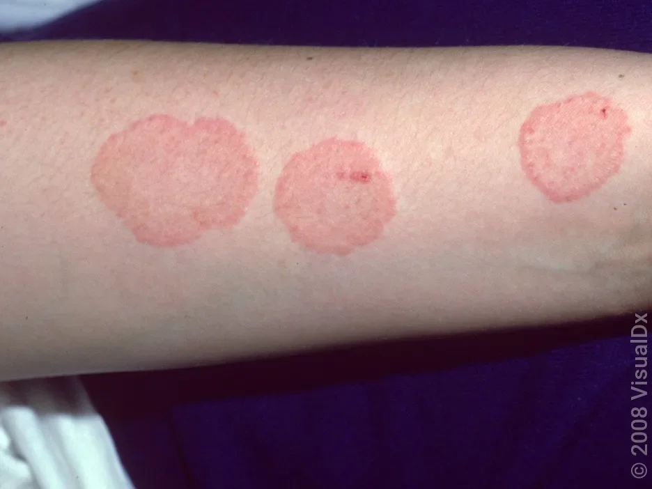 Close-up of the arm with several patches of ringworm.