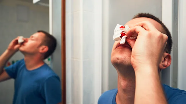 Health: Covid-19: man nosebleed tissue 696227572