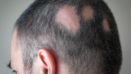 A man with alopecia areata spot baldness is pictured in a close-up.
AlexPapp + via Getty Images Plus