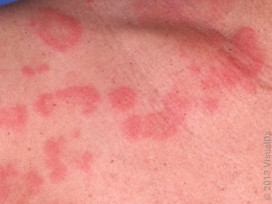 Smaller welts (hives).