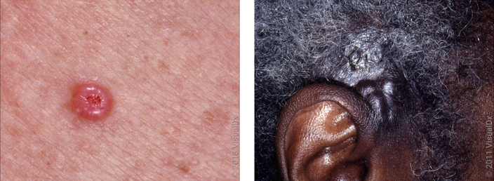 Left: A smooth, round, pink skin bump with a crust in the middle. Right: A large, dark brown, smooth skin growth above the ear. 
