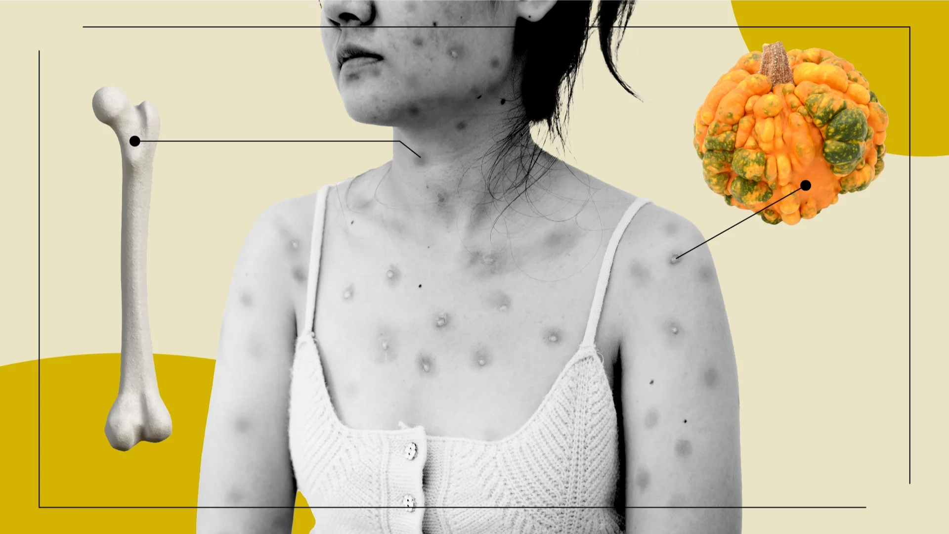 Graphic photo collage of a woman with monkeypox with diagram lines pointing to a femur bone and cooper bullets.