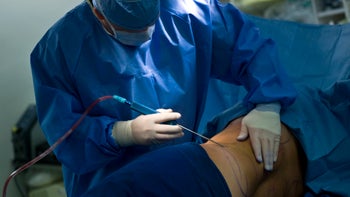 Health: Procedures: liposuction surgery being preformed-157383711