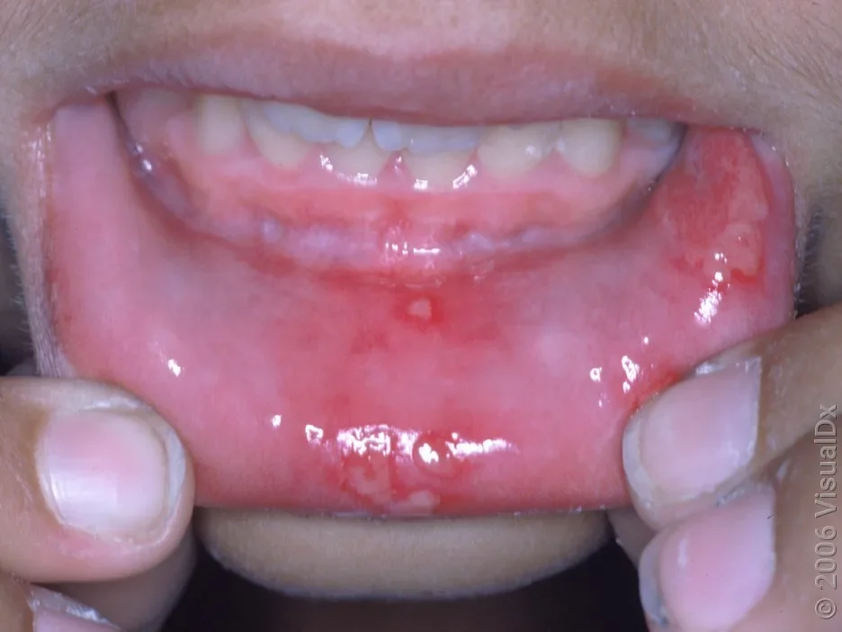 Close-up of several canker sores on the lower lip.