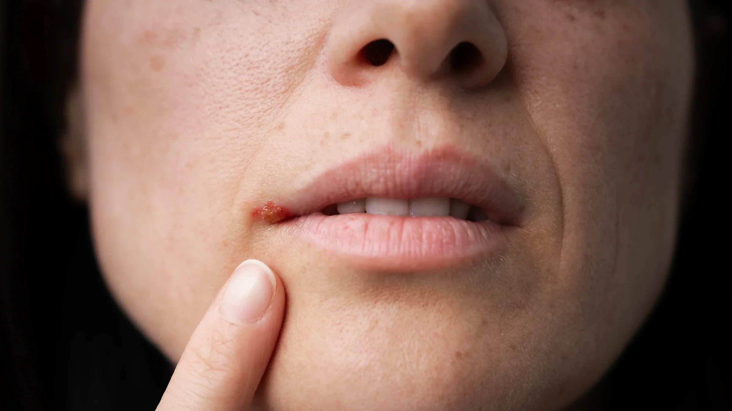 A person is pointing to a cold sore on their lip in a close-up.
batuhan toker/iStock via Getty Images Plus