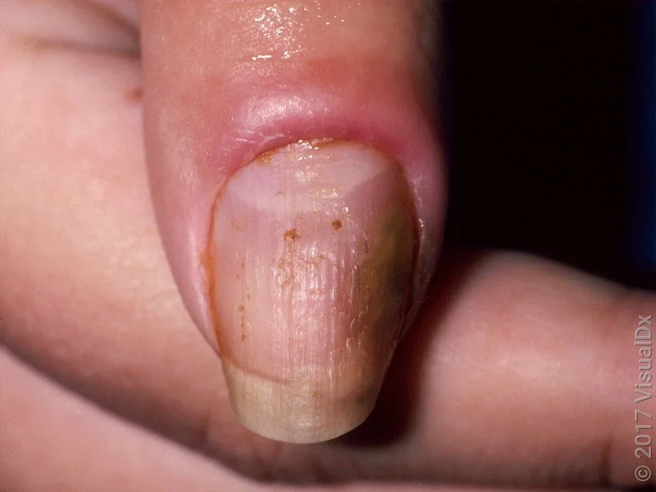 Close-up of finger with nail ridging and redness around the nail. 