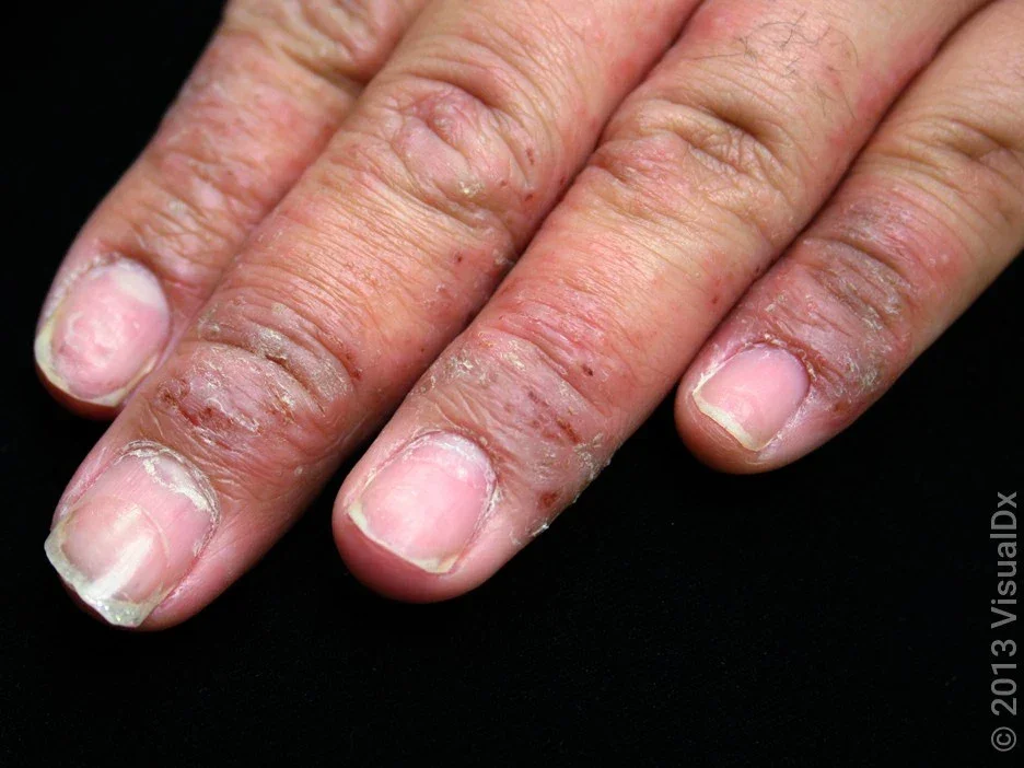 Close-up of eczema blisters and crusting on hands. 
