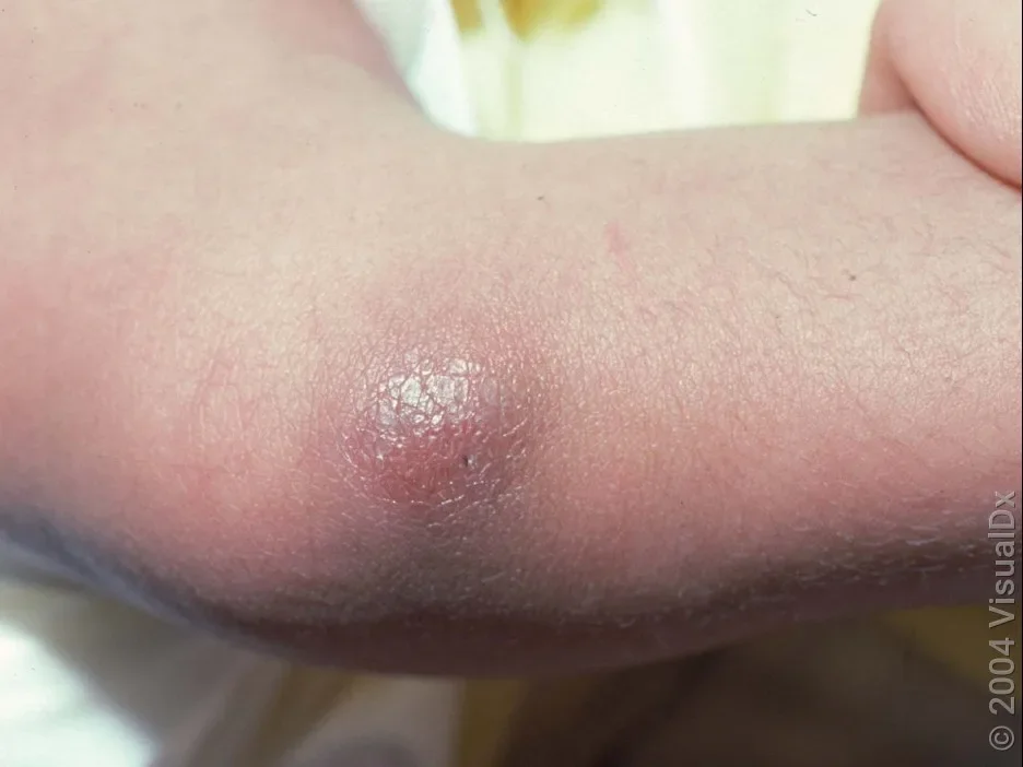 Mild redness in an early cellulitis rash.