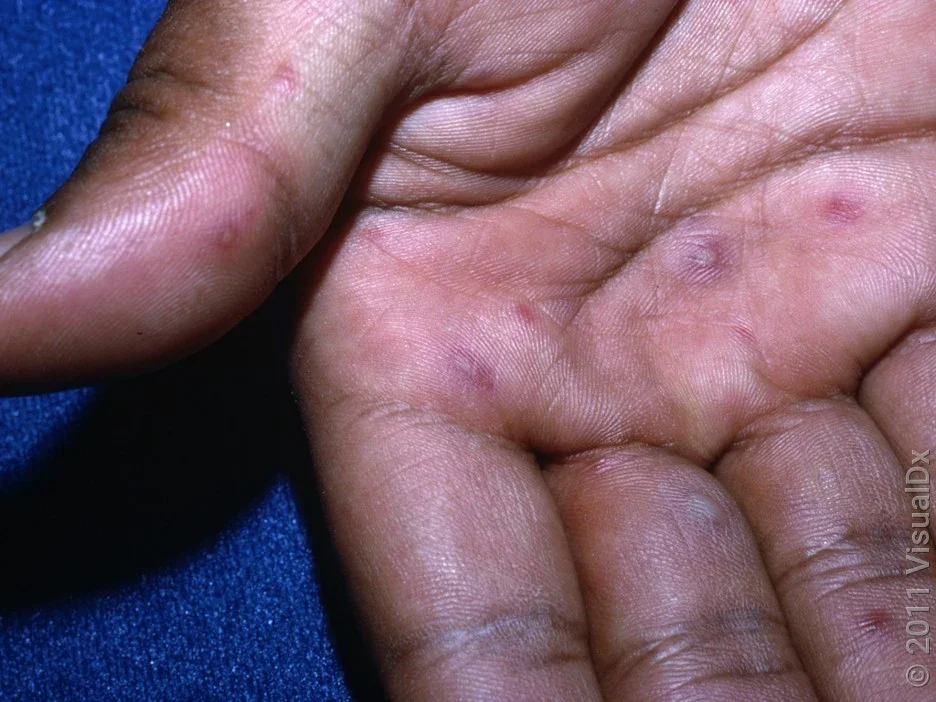 Blisters on hands in more-developed hand, foot, and mouth disease.