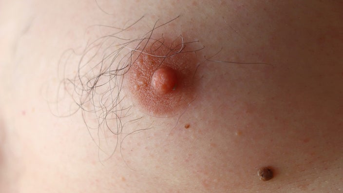 What Does Having a Third Nipple Mean? Supernumerary Nipples - GoodRx
