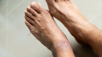 Diabetes: closeup foot ulcer 1184718197