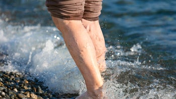Dermatology: Circulation: varicose veins on legs sea 1353662159
