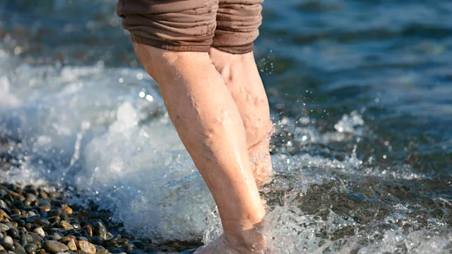 Dermatology: Circulation: varicose veins on legs sea 1353662159
