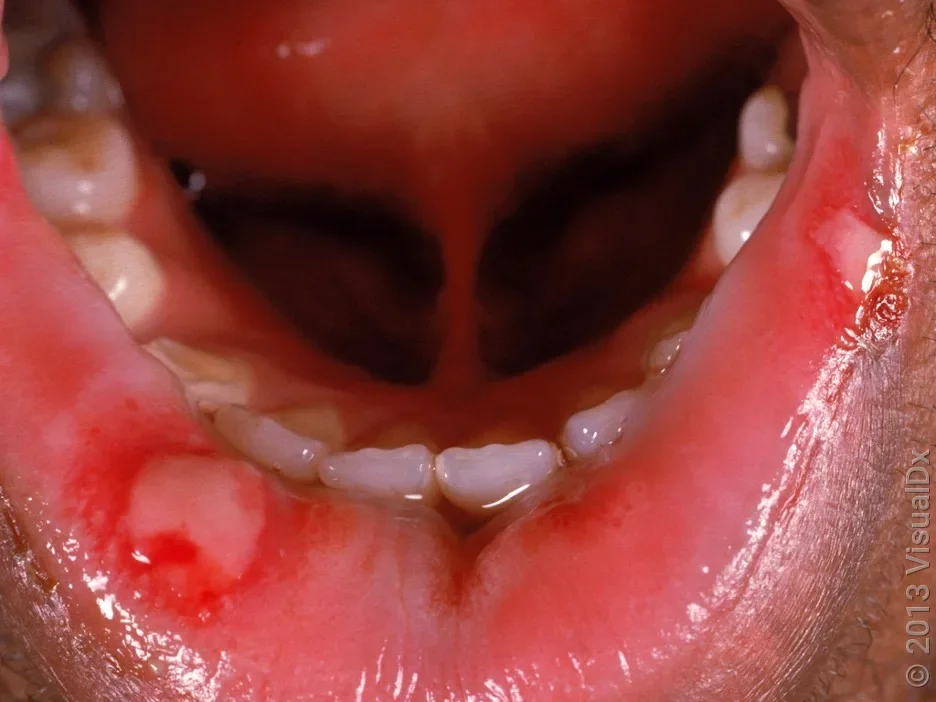 Close-up of a canker sore on the lower lip.