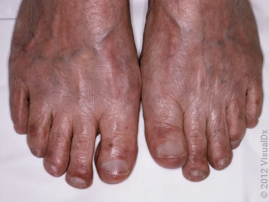 Close-up of chilblains on the toes on darker skin.