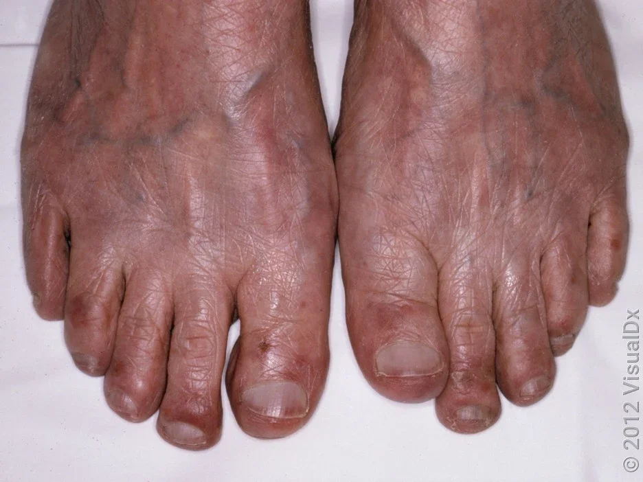 Close-up of chilblains on the toes on darker skin. 
