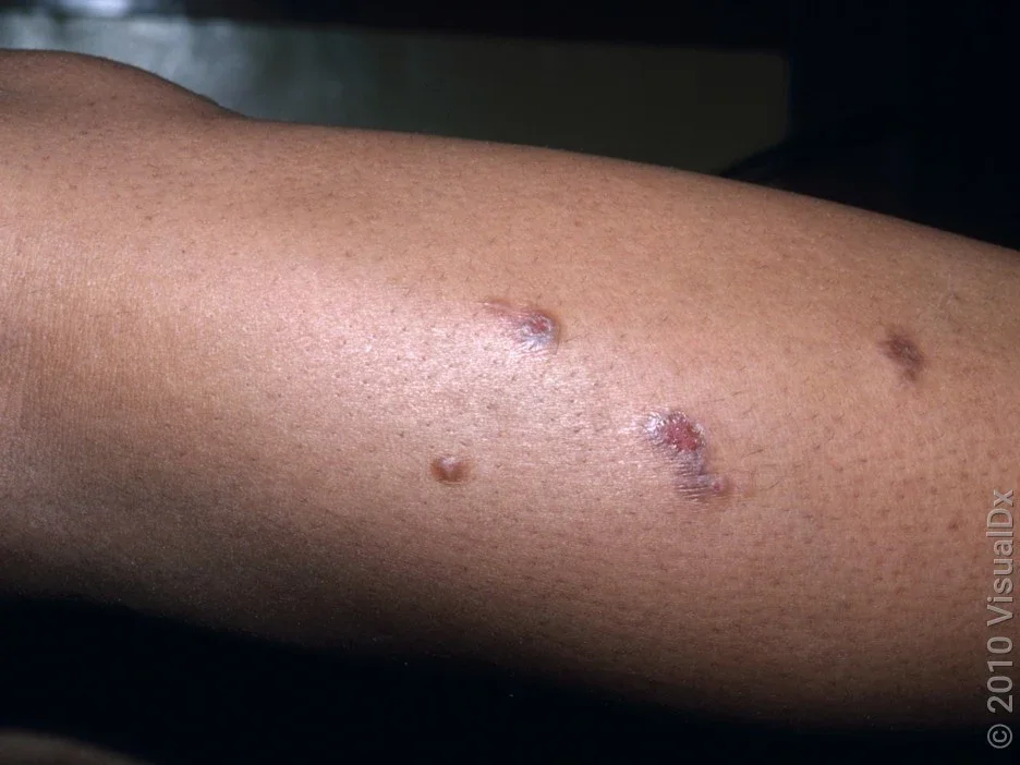 Close-up of the leg with arthropod bites, like from a mosquito.