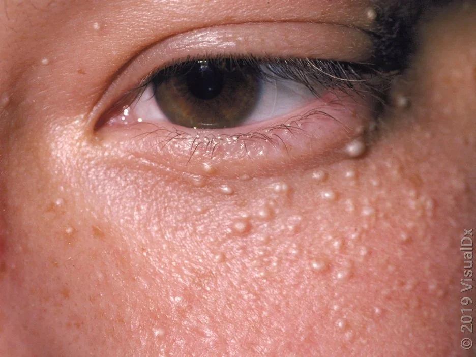 Close-up of milia bumps under the eye.