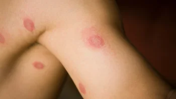 Dermatology: closeup ringworm on arm 176099272