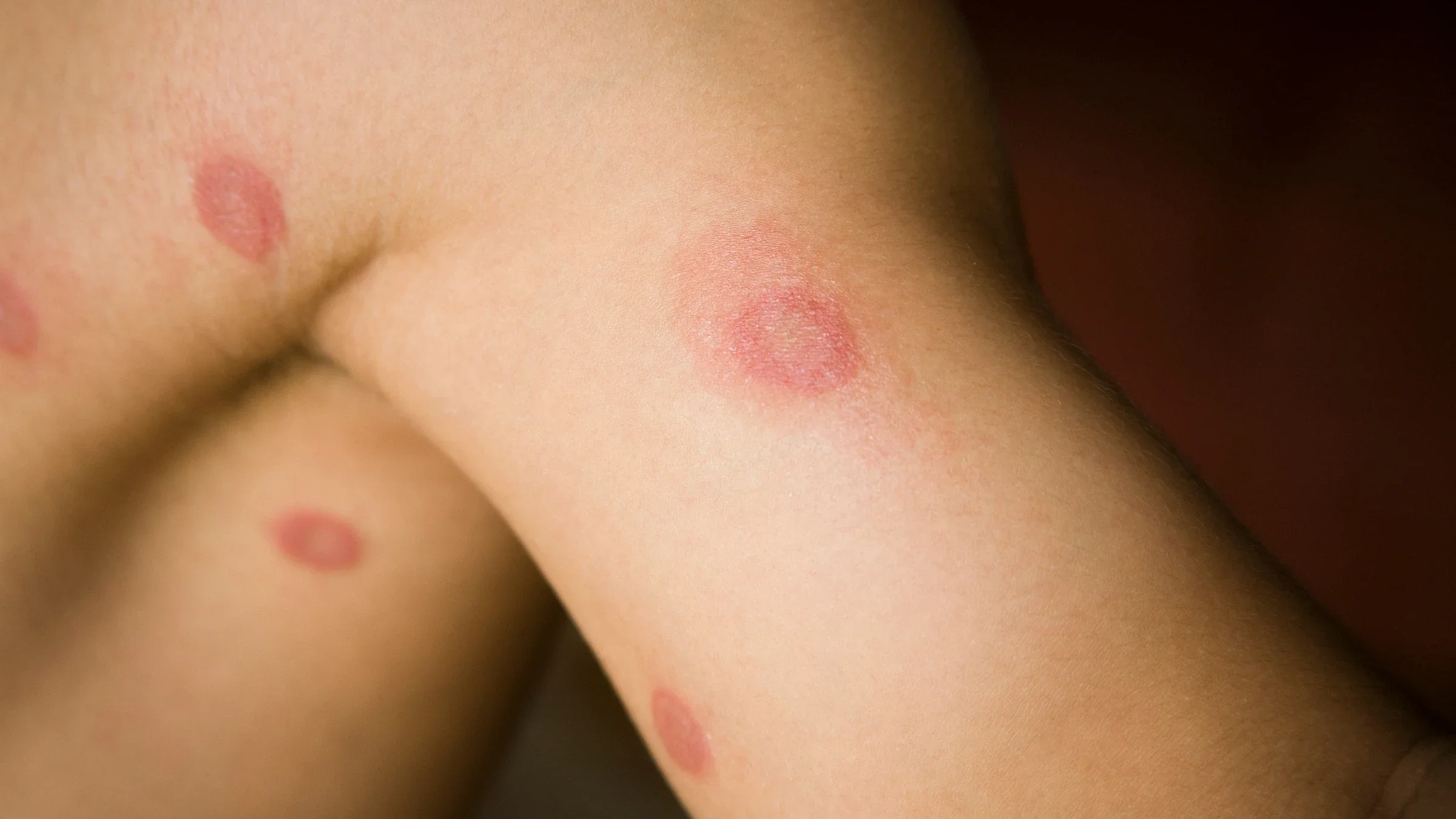 Close-up ringworm on skin
alejandrophotography/iStock via Getty Images Plus