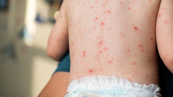 Children's Health: Chicken Pox: closeup child in diaper with chicken pox 1478102344