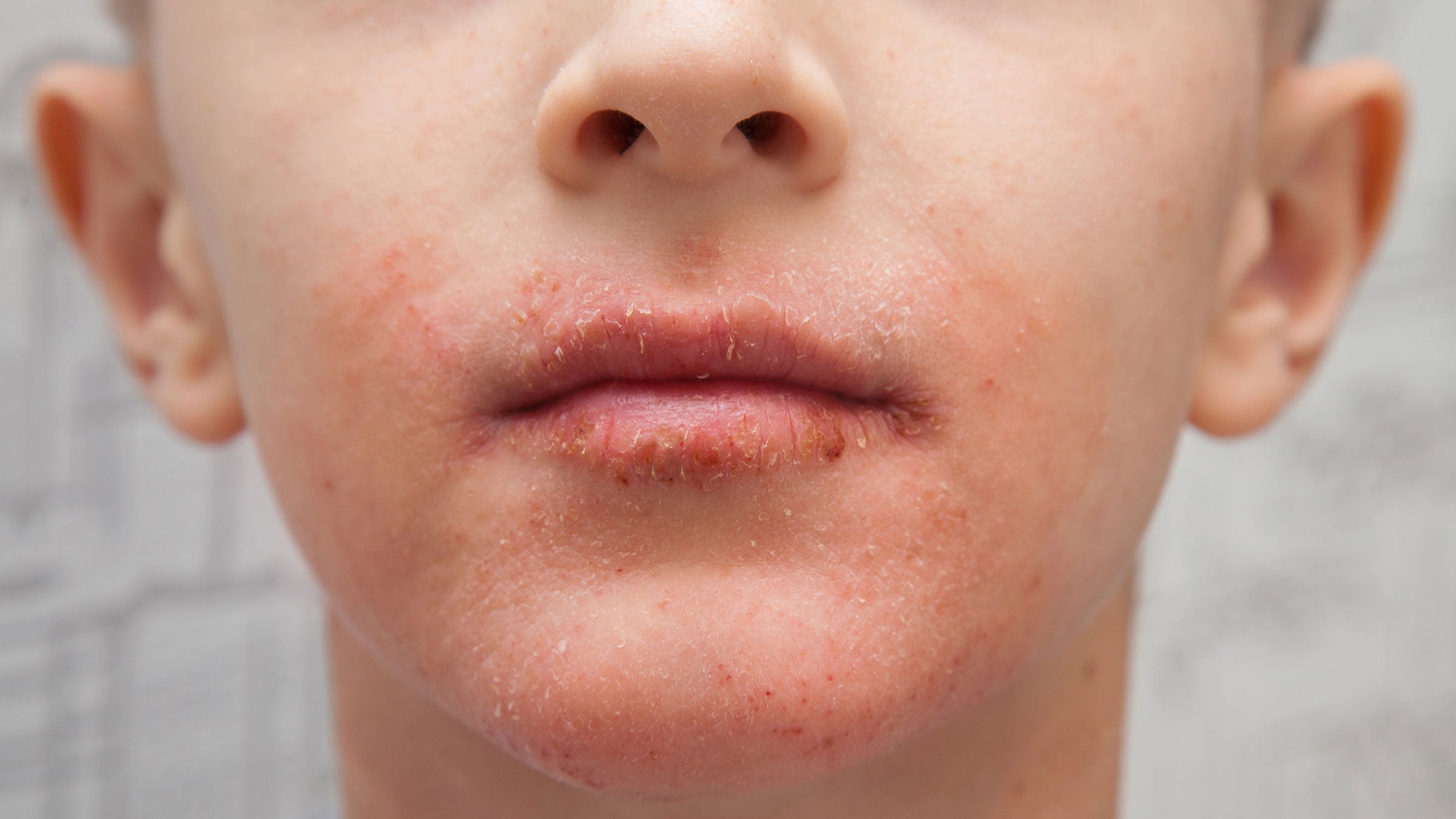 Rash around mouth discount