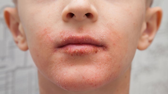 A child has an allergic rash on their face and lips.