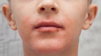 dermatology: close up child with allergy rash on face-1129193848