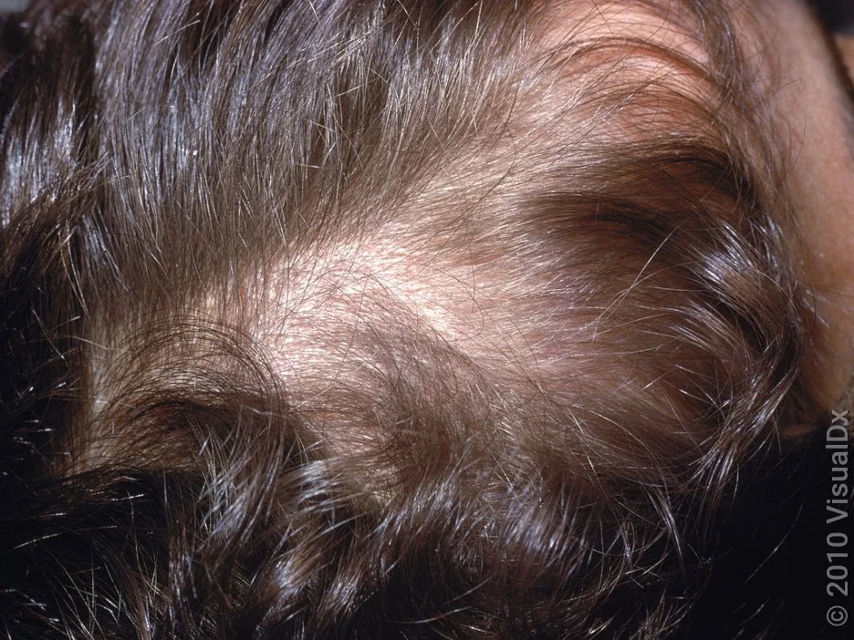 Close-up of scaly patch in scalp psoriasis. 