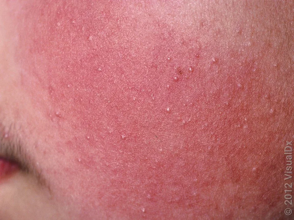 Keratosis pilaris on the face.