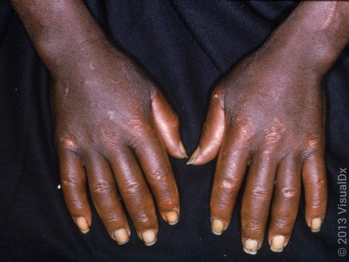 Scleroderma on the hands. 