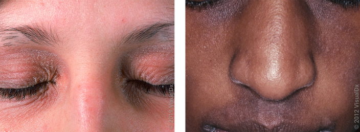 Left: Close-up of closed eyes surrounded by pink patches, thickened eyelids, and lines (eczema). Right: Close-up of a face with dark, thick patches under the eyes and above the lips (eczema).
