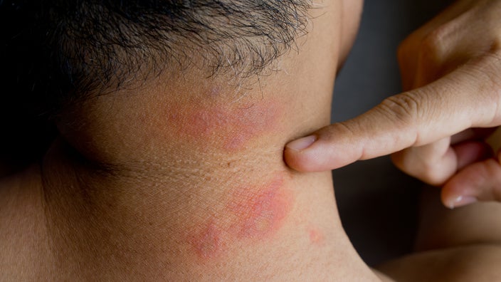 Close-up on a man's neck with bug bites.