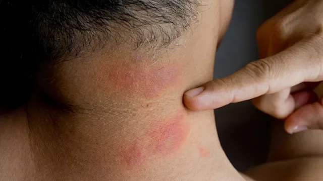 Benadryl: Hydrocortisone cream: bug bites neck-1297422775