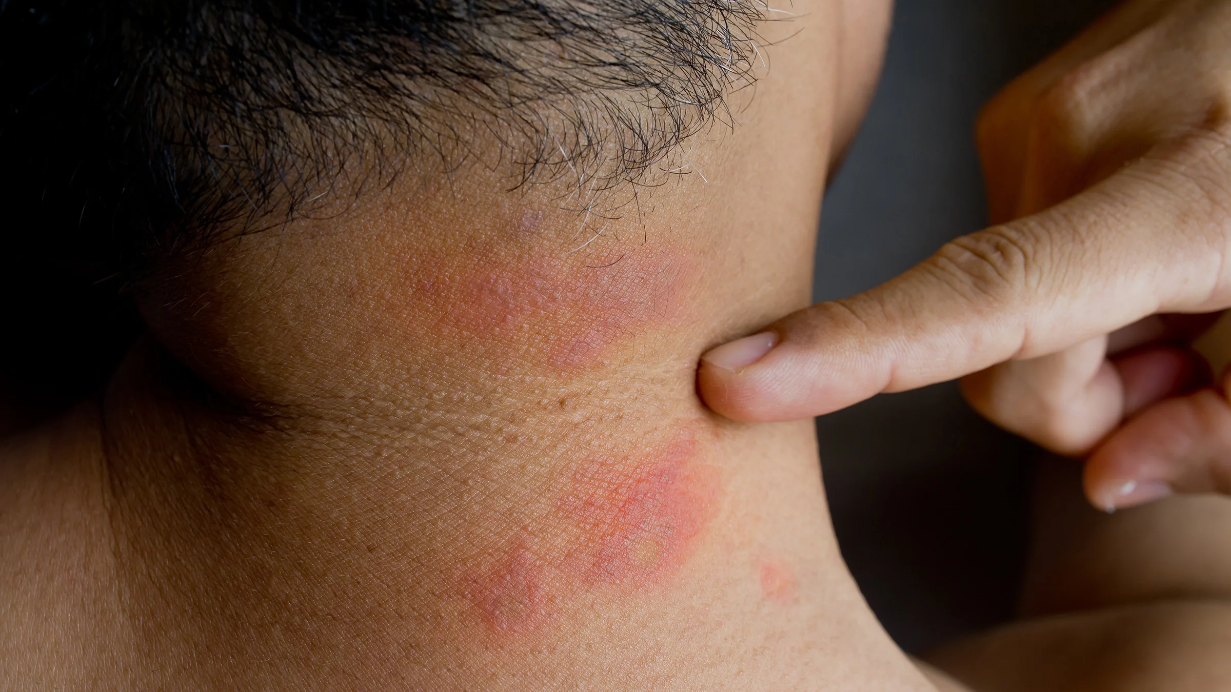 Close-up on a man's neck with bug bites.