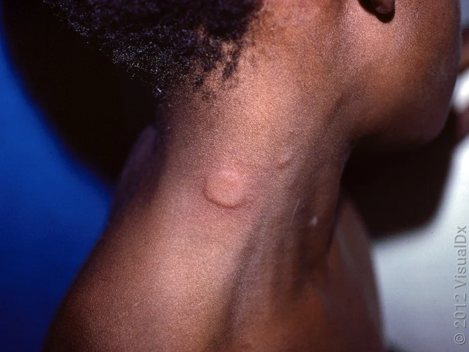 A small welt (hive) on a person’s neck. 