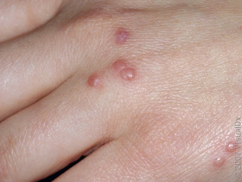 A cluster of pink bug bites on the hand. 