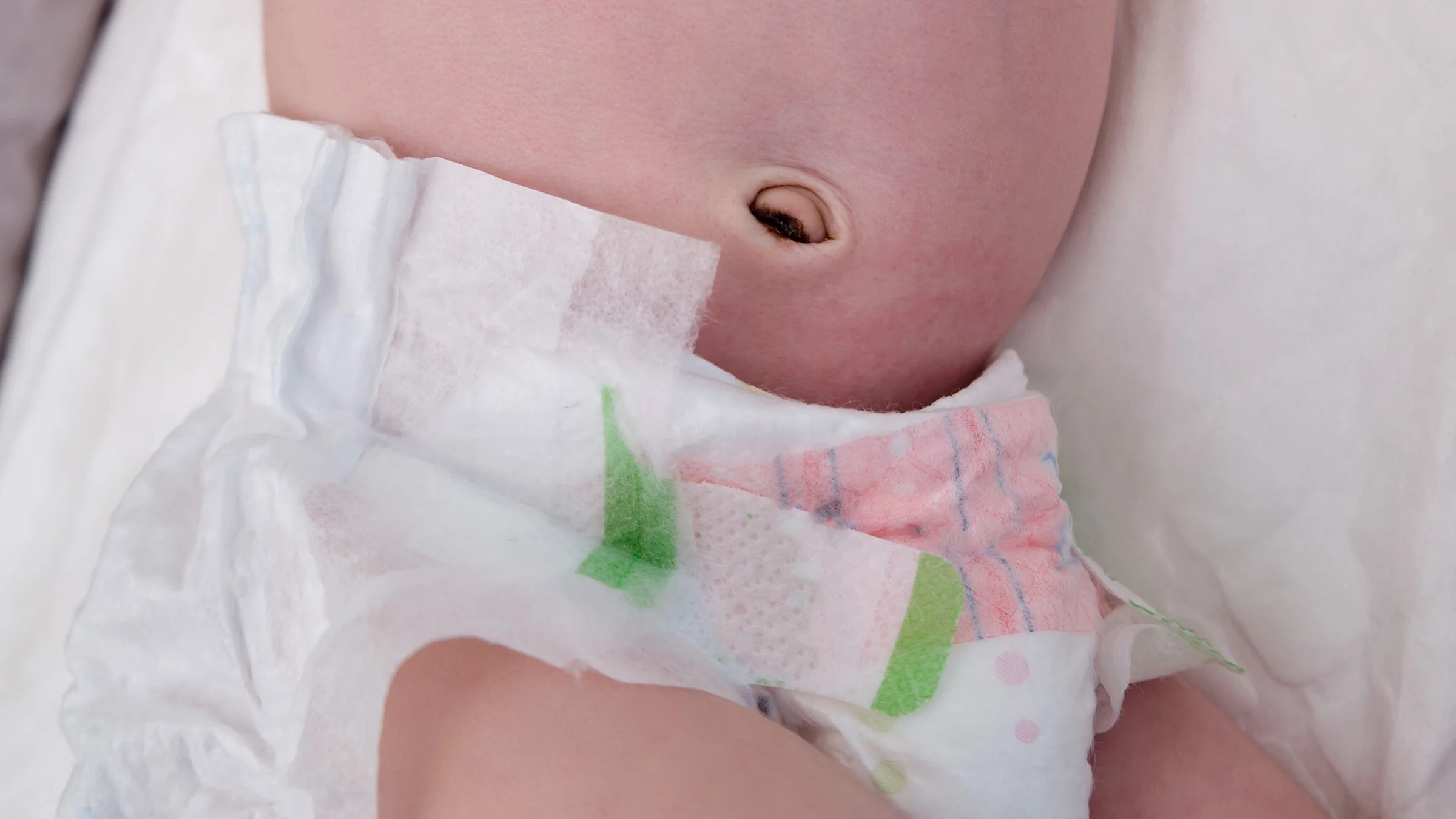 Close-up of a newborn's belly button that shows the umbilical cord sore healing.