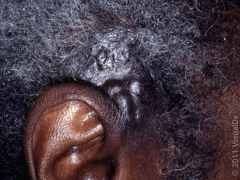 Close-up of a large basal cell carcinoma on Black skin near the ear. 