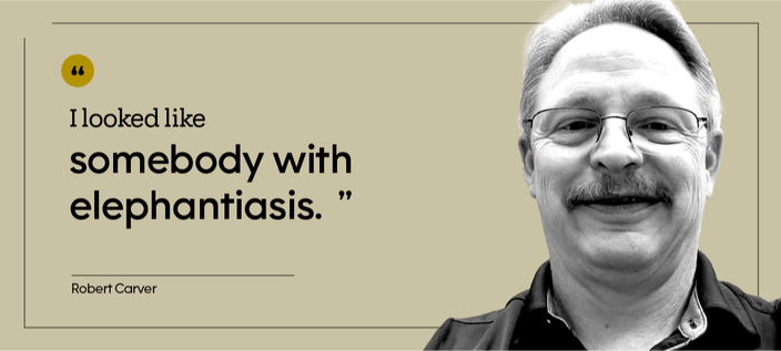 “I looked like somebody with elephantiasis.” — Robert Carver