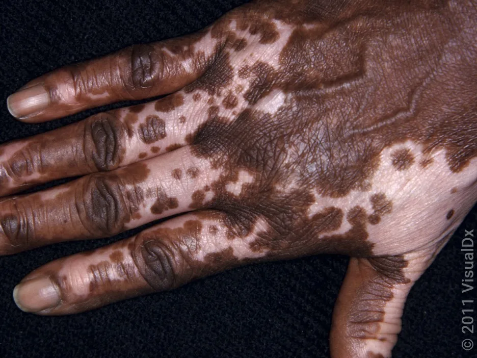 Vitiligo on the hand.