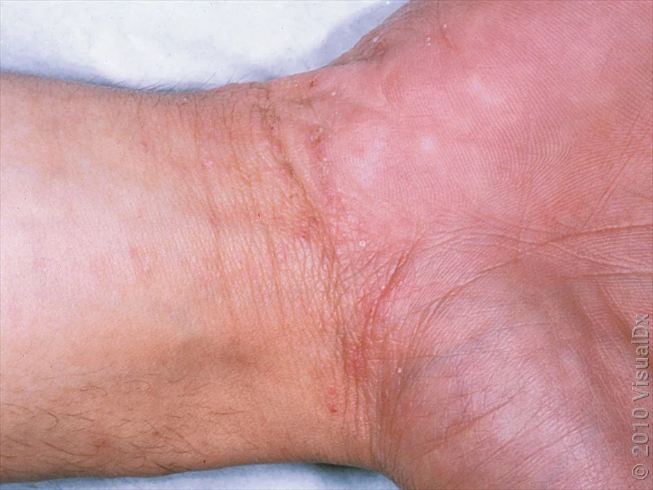 Scabies on the wrist with tiny pink skin bumps. 