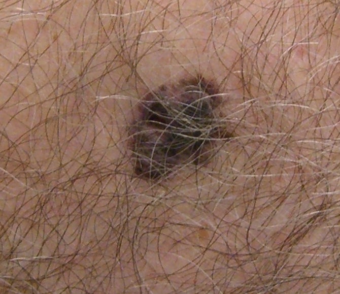 What Does Skin Cancer Look Like? GoodRx