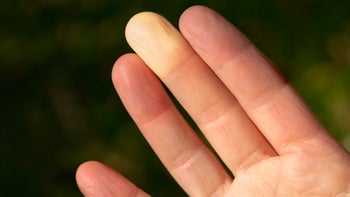 Health: Raynauds phenomenon: pads of fingers one yellow-1356033102