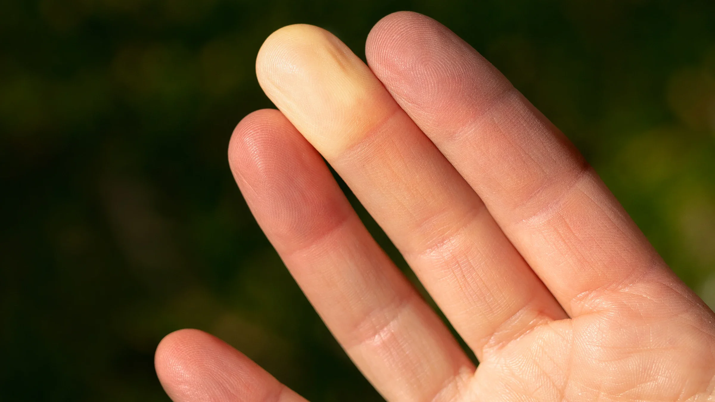 Close-up of the pads of someone's fingers. The middle finger is yellow due to lack of blood flow.
Petra Richli/iStock via Getty Images