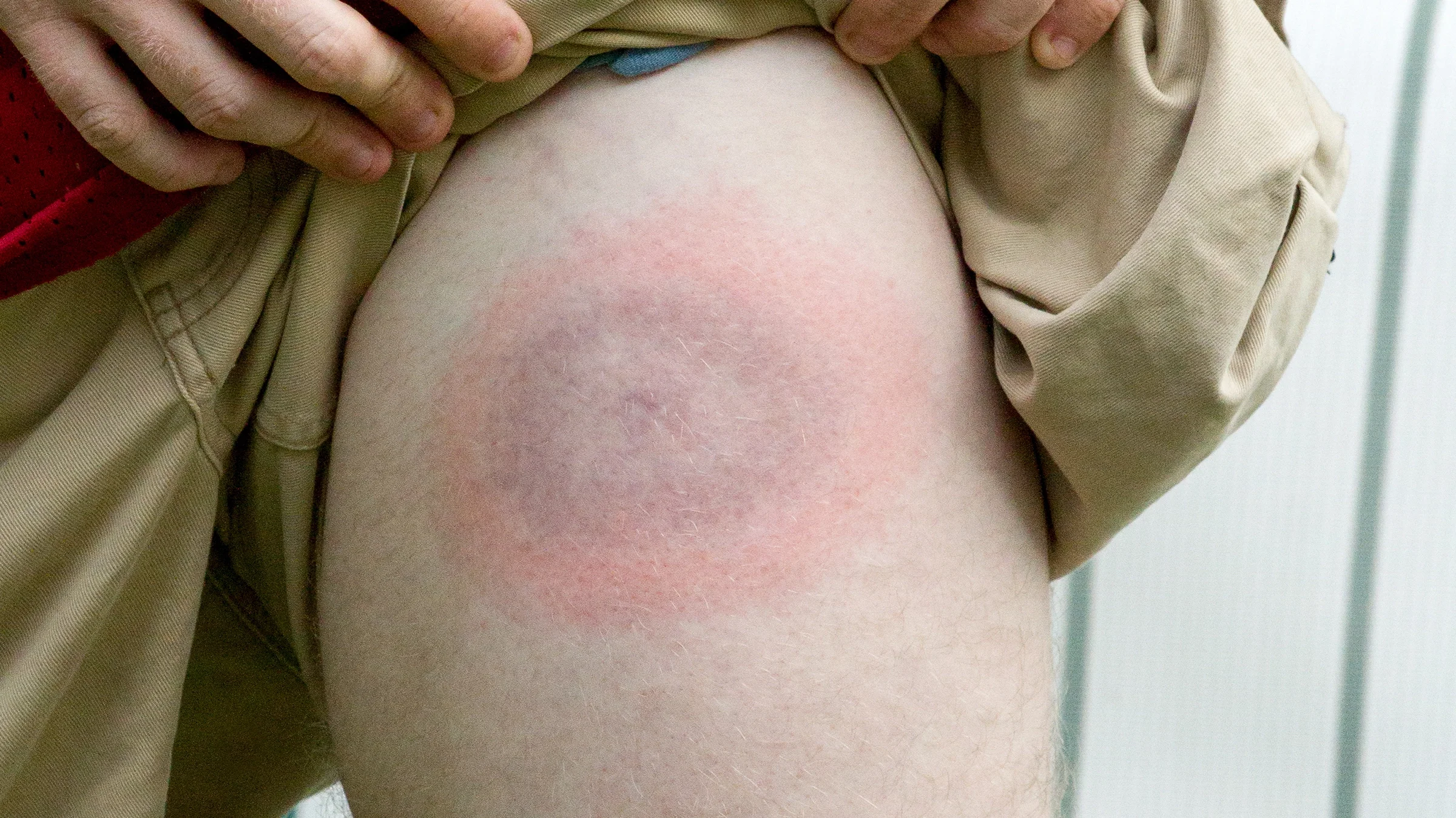 Close-up shot of a person lifting their shorts to show a Lyme disease bullseye.