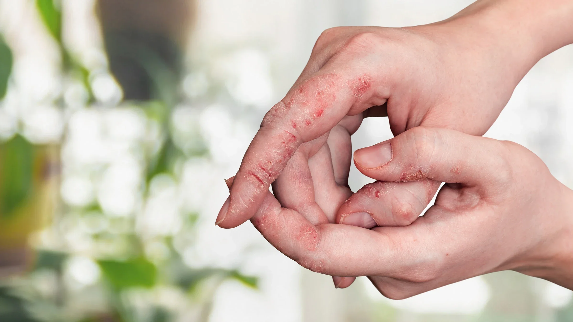A close-up on a person's pointer finger with eczema with cracks in their knuckles.
kobzev3179/iStock via Getty Images
