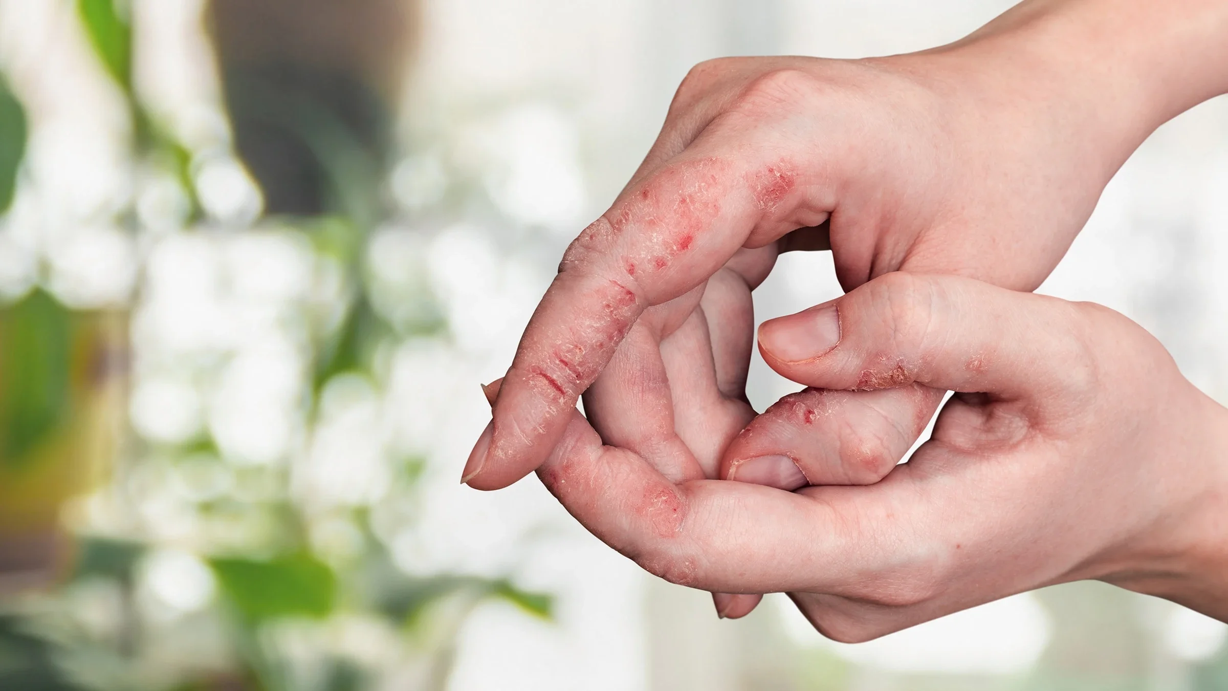 A close-up on a person's pointer finger with eczema with cracks in their knuckles.