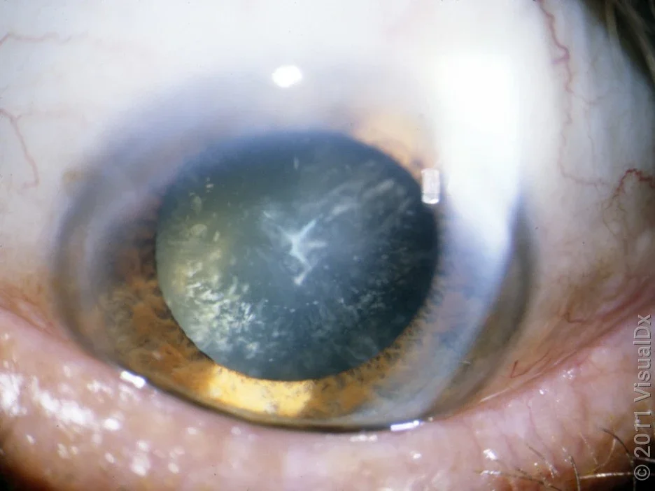 Dilated pupil with speckled cataract, as seen during an eye exam. 